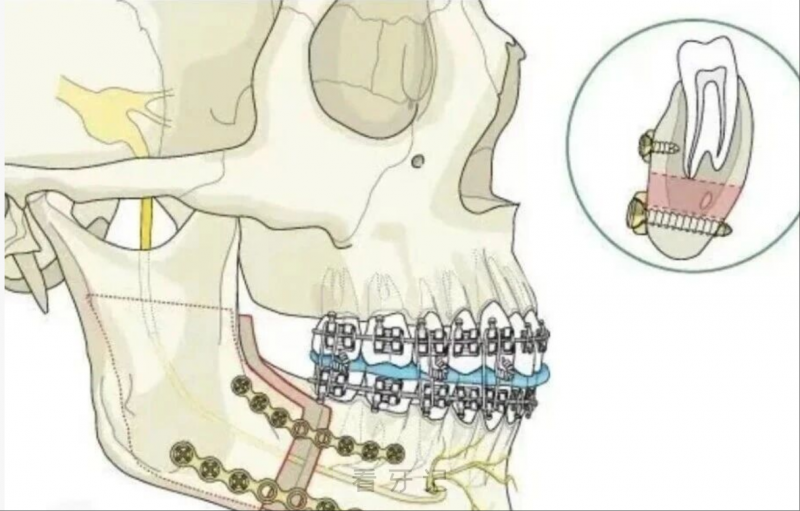 想通过牙套排齐牙齿，正畸医生劝我做正颌，是套路还是真的为我好？口腔业内人冒死揭秘撕开‘手术焦虑’遮羞布！