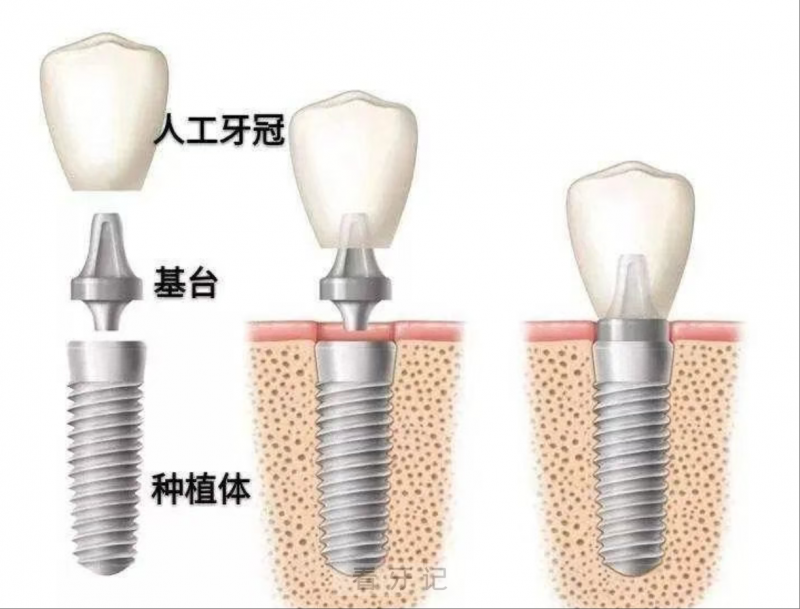 牙科离职揭秘！关于种牙给大家分享牙医不会说的种植牙实话！这5类人根本不适合做种植牙，这3个弊端你一定要了解！附种植牙集采后最新价格