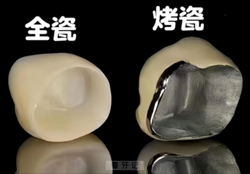 牙套扫盲攻略！牙医朋友偷偷告诉我的做牙冠必知 3 个要素！全瓷/烤瓷牙冠哪个好？怎么选？那种品牌的牙冠寿命更耐用？附牙冠价格表