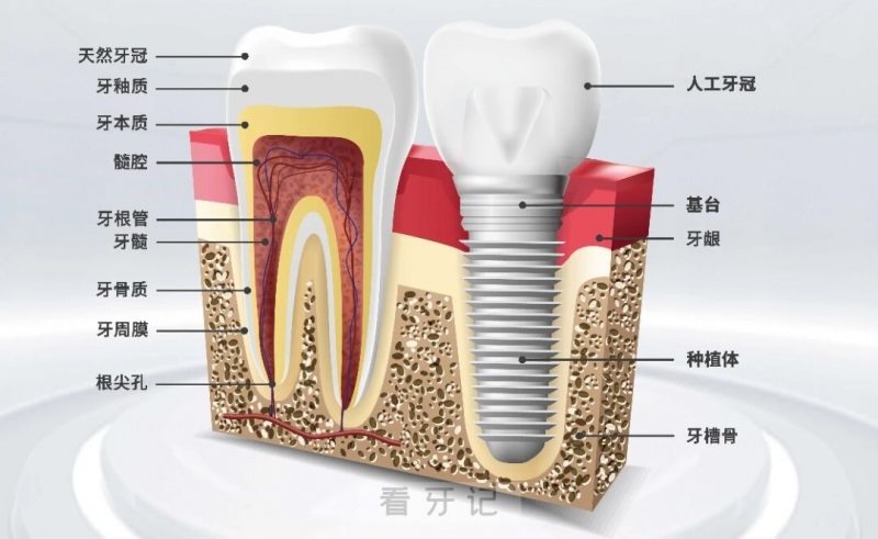 缺牙后吃饭是个大麻烦！幸福感也会直线下降！那么镶牙和种植牙选谁好呢？ 镶牙好还是种牙好？