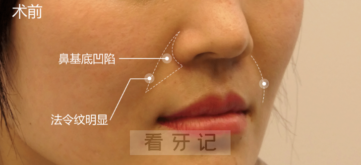 正畸拔牙攻略！正畸千万不要拔牙？正畸拔牙后反而瘪嘴显老是什么原因？