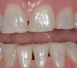 牙齿为什么会磨损？牙齿磨损是正常现象吗？牙齿严重磨损怎么办？