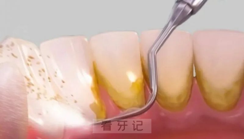 良心牙医揭秘洗牙牙齿疼痛敏感三大内幕