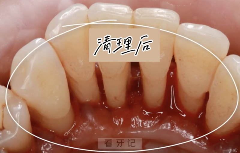 松动的牙齿经过治疗后利用松牙固定术是可以避免拔牙的吗？哪些松动牙可以固定？